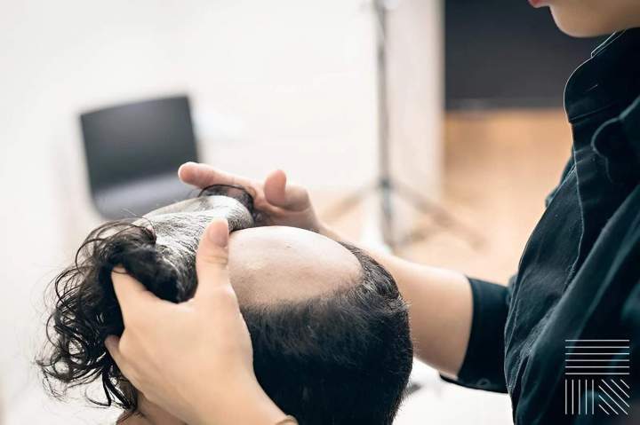 Hair replacement for beautiful hair.